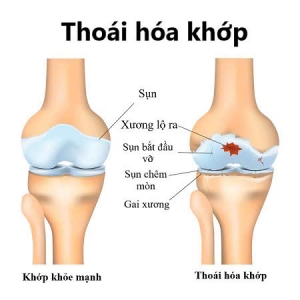 4 GIAI ĐOẠN CỦA THOÁI HÓA KHỚP