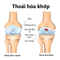 4 GIAI ĐOẠN CỦA THO&Aacute;I H&Oacute;A KHỚP