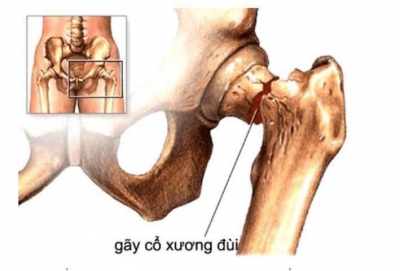 🚨 G&Atilde;Y CỔ XƯƠNG Đ&Ugrave;I &ndash; ĐỪNG CHỦ QUAN V&Igrave; C&Oacute; THỂ ĐE DỌA T&Iacute;NH MẠNG! 🚨