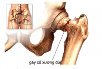 🚨 G&Atilde;Y CỔ XƯƠNG Đ&Ugrave;I &ndash; ĐỪNG CHỦ QUAN V&Igrave; C&Oacute; THỂ ĐE DỌA T&Iacute;NH MẠNG! 🚨
