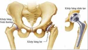 THAY KHỚP HÁNG NHÂN TẠO – BAO LÂU CÓ THỂ ĐI LẠI?