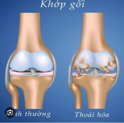 **THO&Aacute;I H&Oacute;A KHỚP L&Agrave; G&Igrave;? HIỂU Đ&Uacute;NG ĐỂ ĐIỀU TRỊ HIỆU QUẢ**